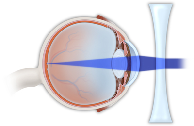 Corrected Myopia / Nearsightedness