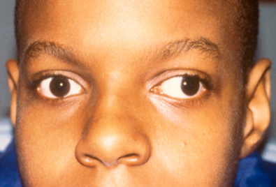 Exotropia (Out-Turned Eyes)
