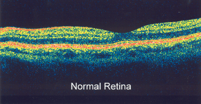 OCT Results - Normal Retina
