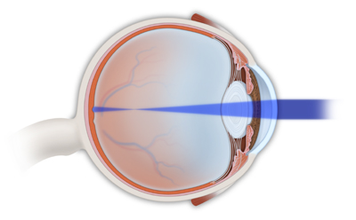 Uncorrected Myopia / Nearsightedness